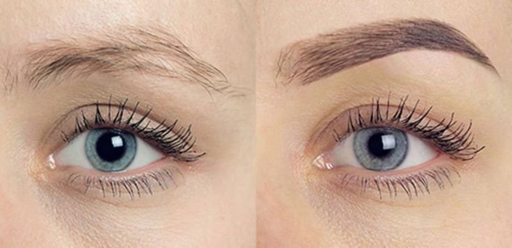 Eyebrow Transplant