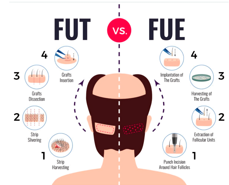 Hair Transplant Procedure