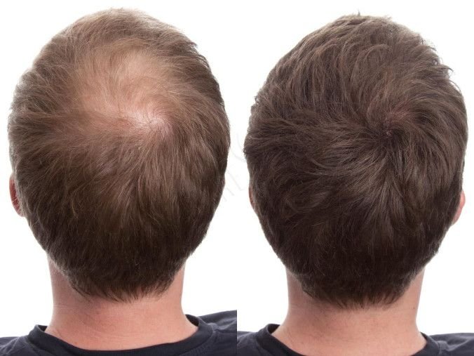 Hair Booster Program