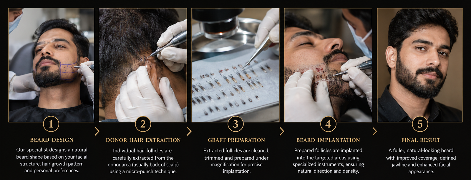 Beard Transplant Process