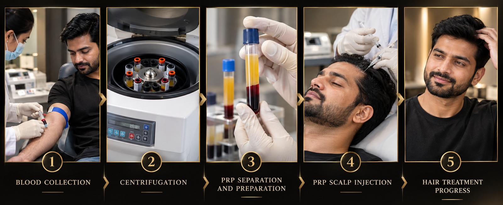 PRP hair treatment for hair loss at Avanza Clinic