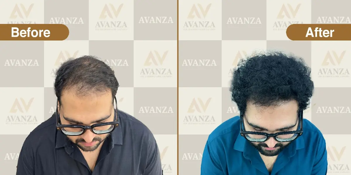 Before and after hair transplant results