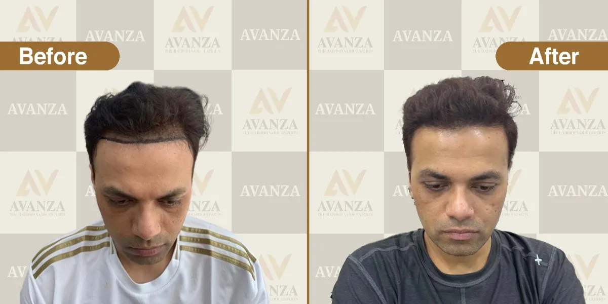Hair transplant results